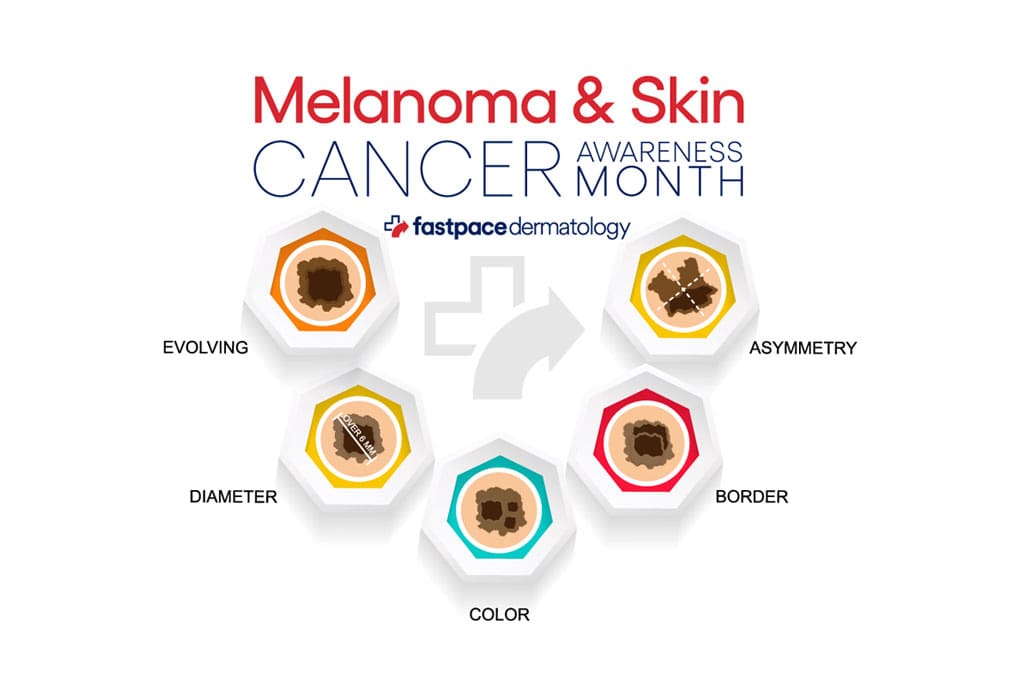 Be Sun Smart: Understanding and Preventing Melanoma - Martinsville Chamber  of Commerce